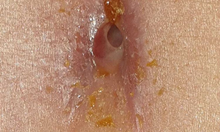 Problemas con ombligo tras abdominoplastia - 83188
