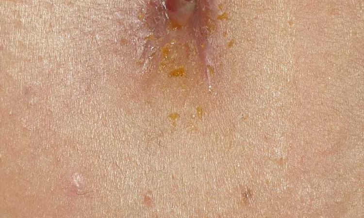 Problemas con ombligo tras abdominoplastia - 83189