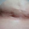 Mastoplexia en T elevación de pecho