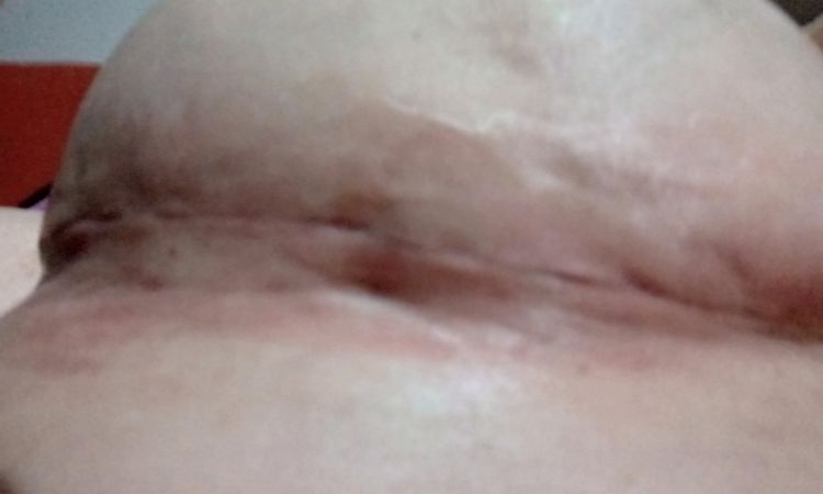Mastoplexia en T elevación de pecho - 83316
