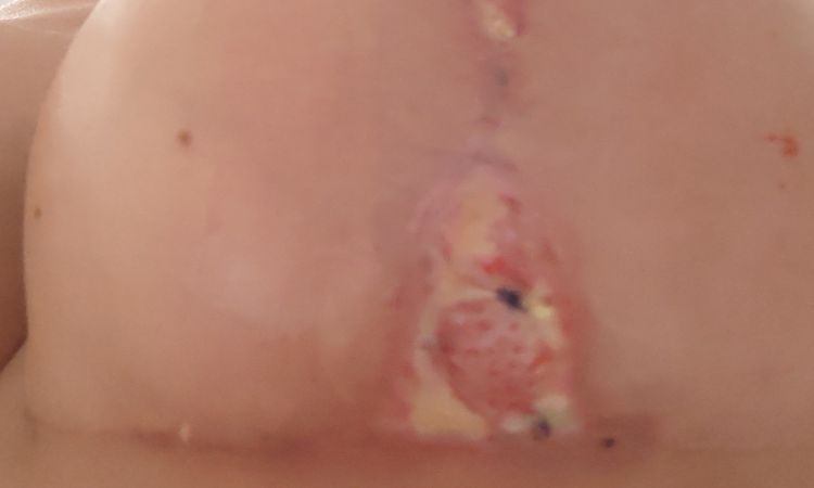 ¿Qué crema o pomada me puede ayudar a cicatrizar? - 83343