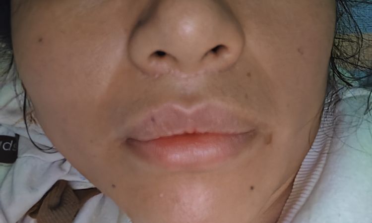 Liftin de labios mal hecho - 83362