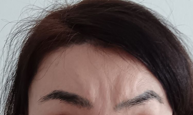 Cirugía para bajar cejas tras frontoplastia - 83380