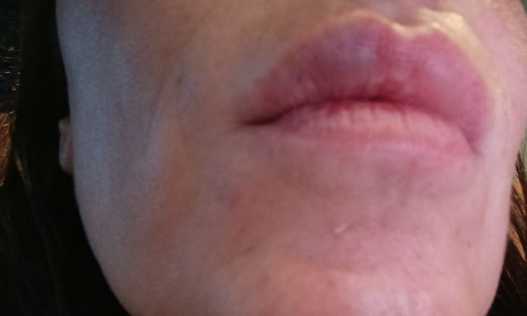 Relleno labios bulto azul - 83383