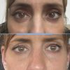 Bleforoplastia inferior