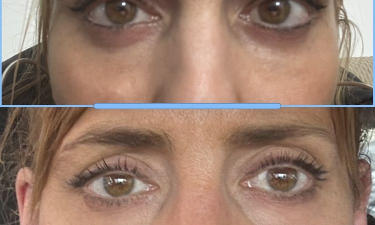 Bleforoplastia inferior - 83385