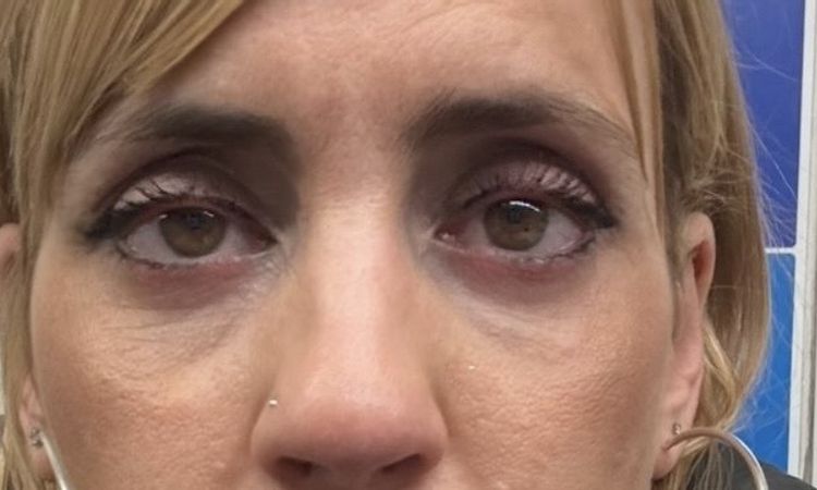 Bleforoplastia inferior - 83386