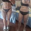 Irregularidades post lipovaser piernas completas
