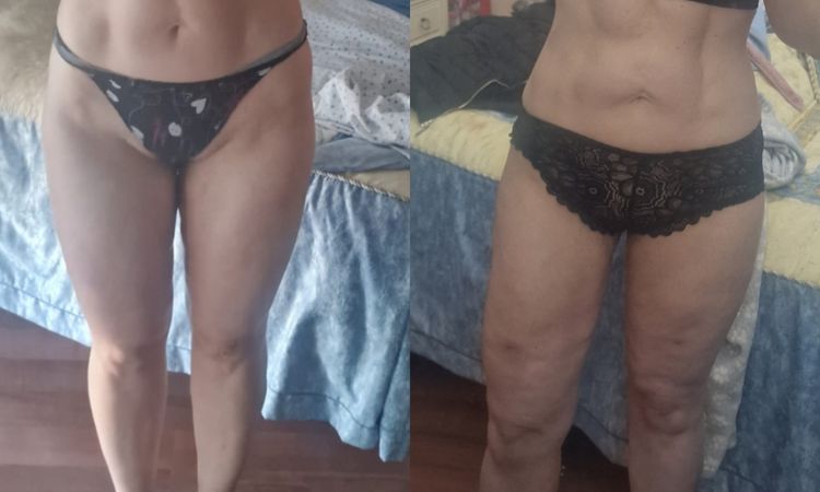 Irregularidades post lipovaser piernas completas - 83394