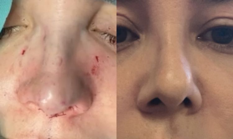 Rinoplastia quería corregir desviación y está igual - 83396