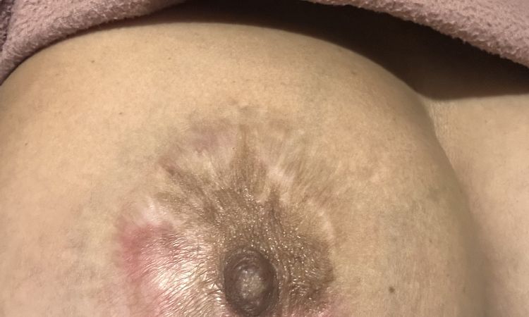 Mastopexia con necrosis hace 8 meses - 83399