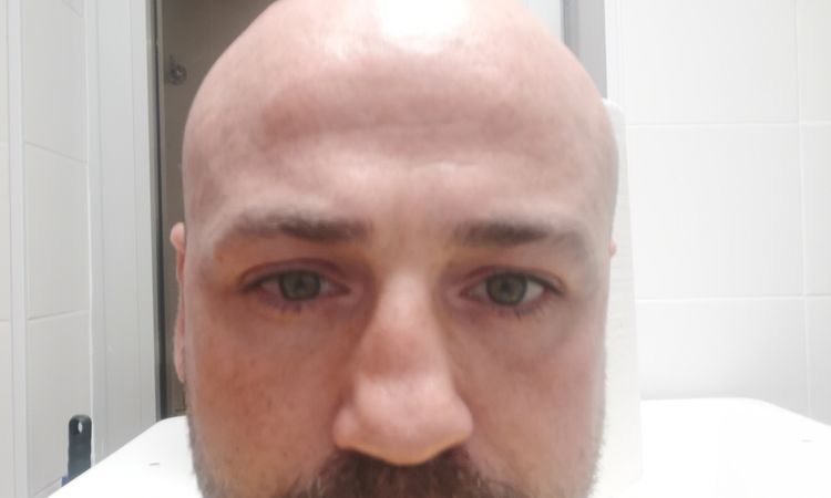 Septoplastia con complicaciones - 83443