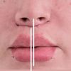 Nariz no está centrada con mi boca después de lifting de labios