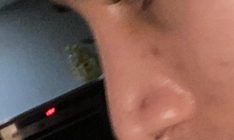 RINOPLASTIA PUNTA NASAL - 83581