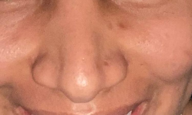 RINOPLASTIA PUNTA NASAL - 83582