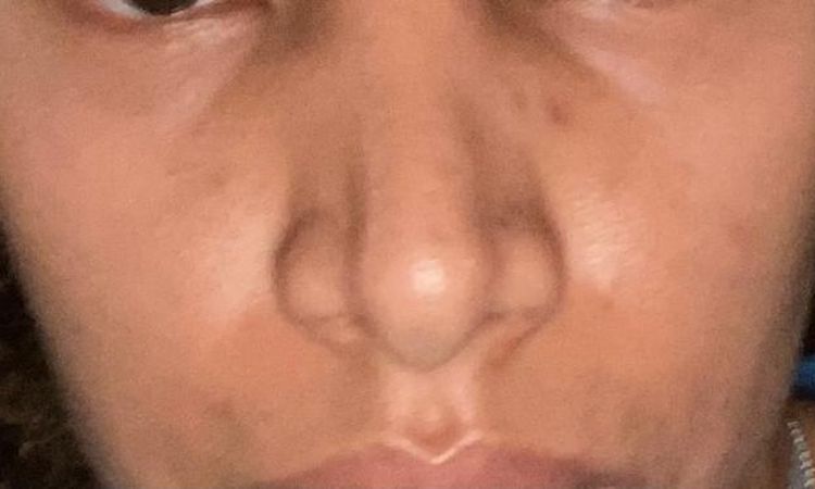 RINOPLASTIA PUNTA NASAL - 83583