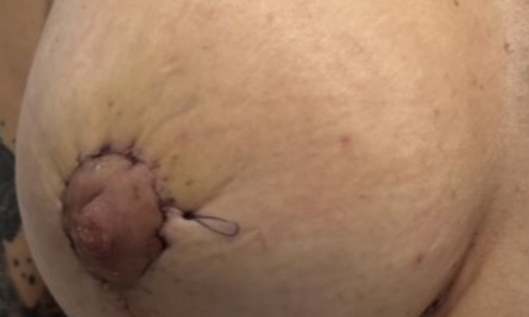 Hematoma en el pecho alrededor del pezón, tras mastopexia. - 83665