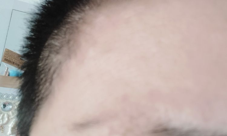 Me quemaron el vello de mi ceja con IPL - 83677