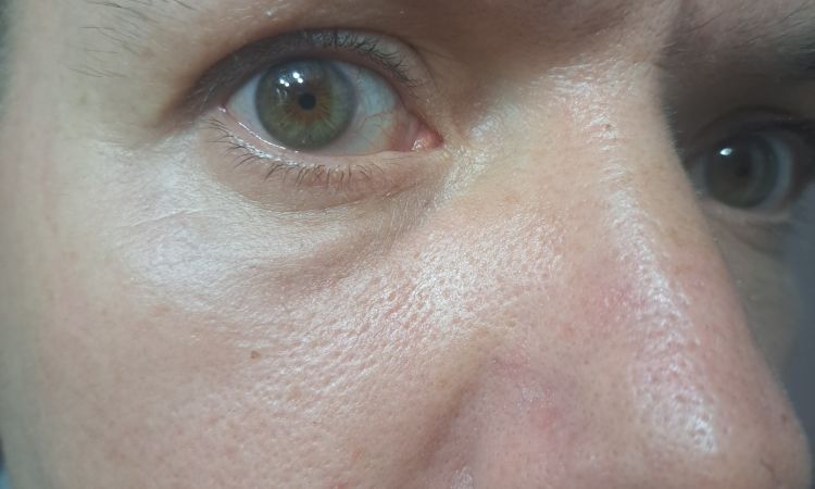 Blefaroplastia con lipofilling ojeras diferencias entre los dos ojos - 83701