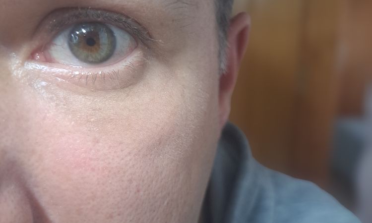 Blefaroplastia con lipofilling ojeras diferencias entre los dos ojos - 83702