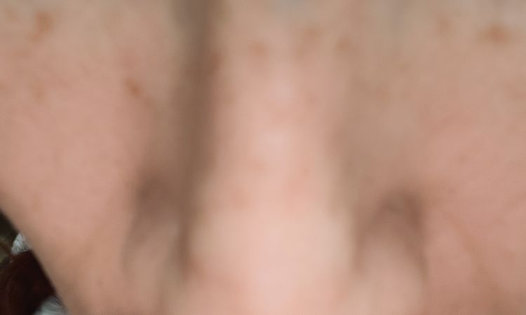 Moretón en el tabique después de una rinoplastia relaizada mas de 8 meces - 83777