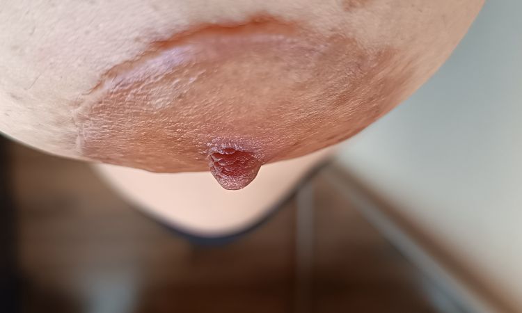 Qué cicatrices tengo;queloides o hipertrófica y cómo tratarlas - 83778