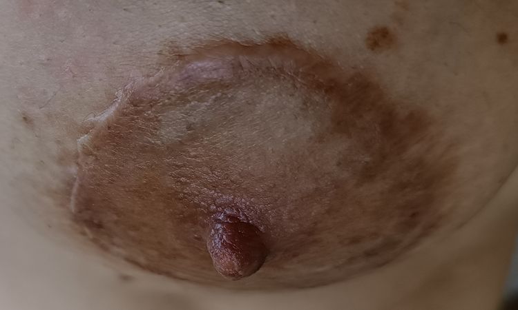 Qué cicatrices tengo;queloides o hipertrófica y cómo tratarlas - 83779