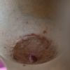Qué cicatrices tengo;queloides o hipertrófica y cómo tratarlas