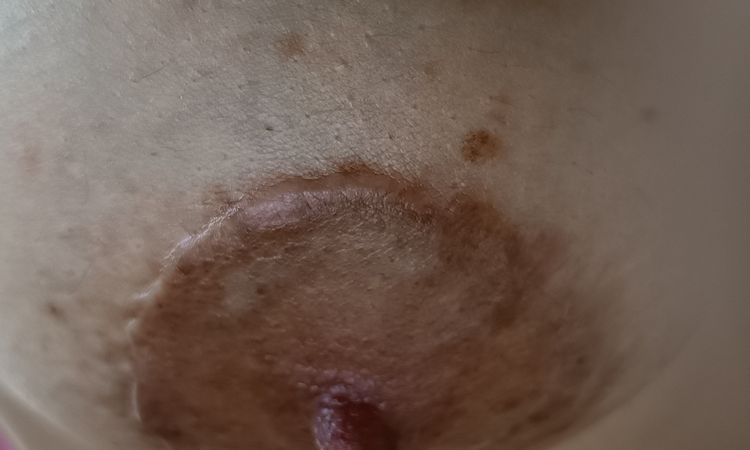 Qué cicatrices tengo;queloides o hipertrófica y cómo tratarlas - 83780