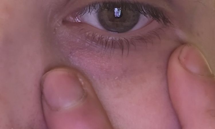 Ojeras vasculares piel fina y reactiva/rosacea - 83787