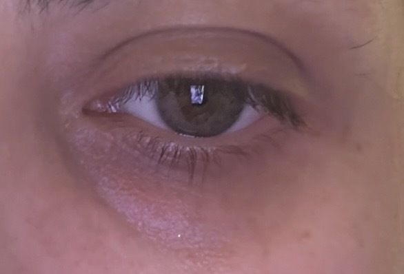 Ojeras vasculares piel fina y reactiva/rosacea - 83788