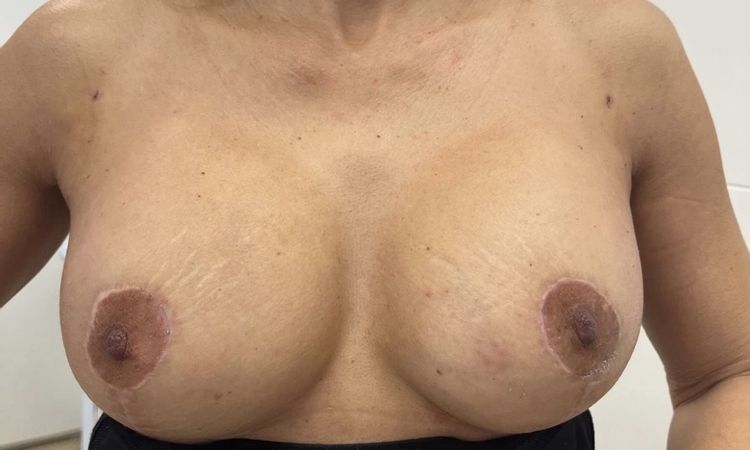 CAMBIO DE PROTESIS POR ASIMETRIA - 83806