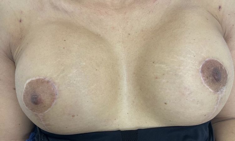 CAMBIO DE PROTESIS POR ASIMETRIA - 83807