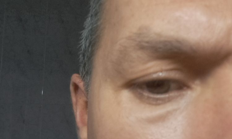 Blefaroplastia transconjuntival con lipofilling - 83831