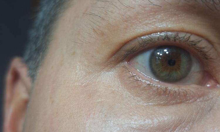 Blefaroplastia transconjuntival con lipofilling - 83832