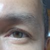 Blefaroplastia transconjuntival con lipofilling