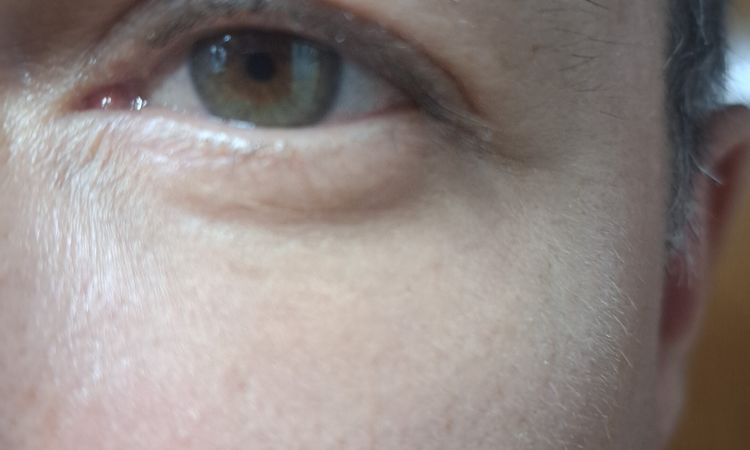 Blefaroplastia transconjuntival con lipofilling - 83833