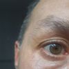 Blefaroplastia transconjuntival con lipofilling