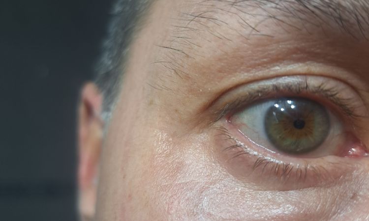 Blefaroplastia transconjuntival con lipofilling - 83834