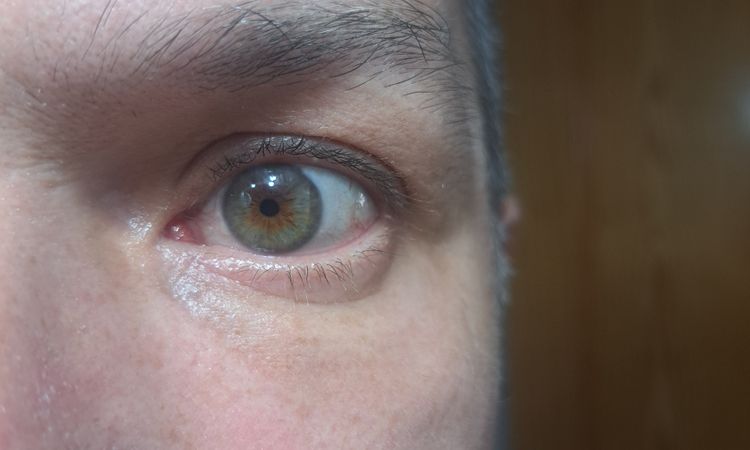 Blefaroplastia transconjuntival con lipofilling - 83835