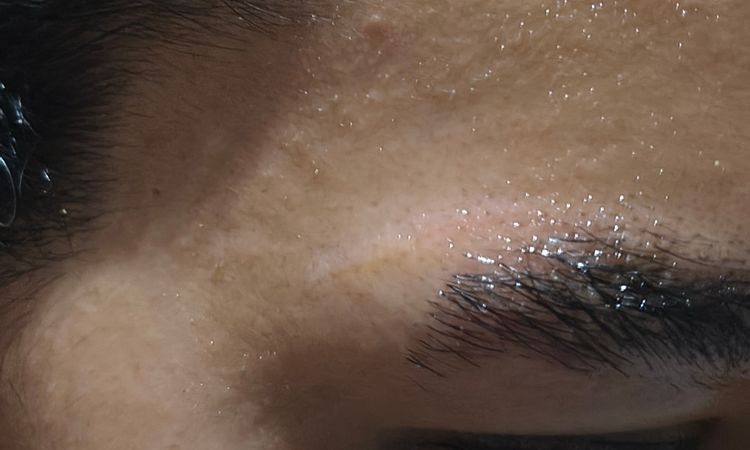 Linea Blanca después de láser de tatuajes - 83867