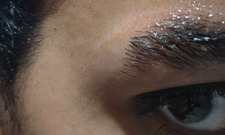 Linea Blanca después de láser de tatuajes - 83868