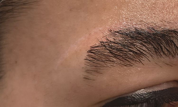 Linea Blanca después de láser de tatuajes - 83869