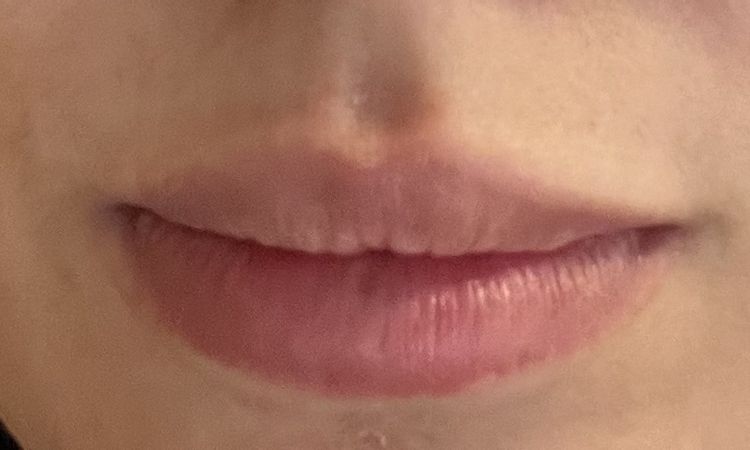 Queiloplastia inferior de hace años - 83913