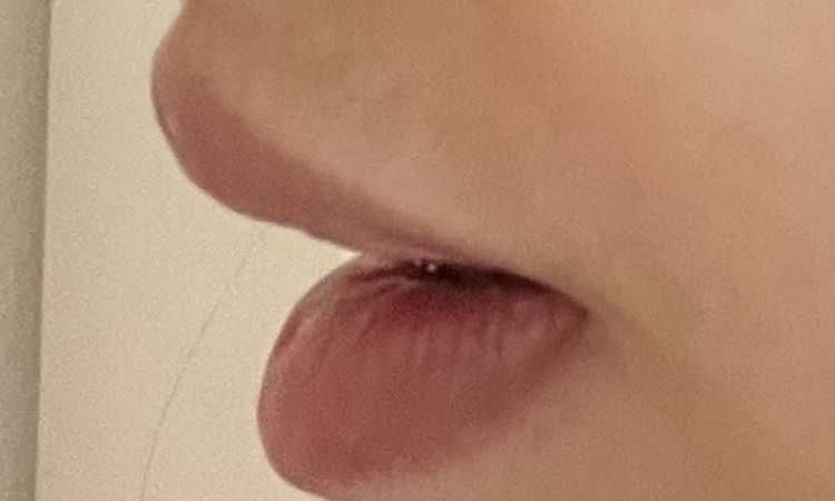 Queiloplastia inferior de hace años - 83914