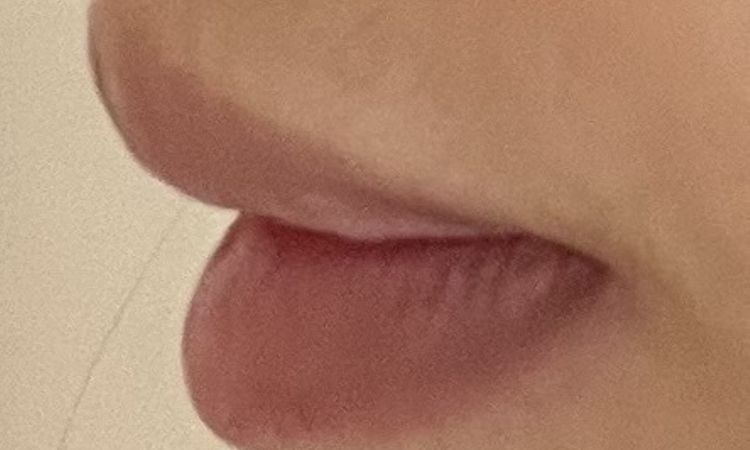 Queiloplastia inferior de hace años - 83915