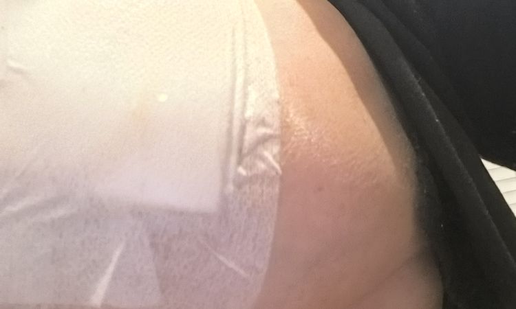 Maxtopexia mal hecha - 83923