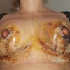 Posible necrosis de areola tras mastopexia