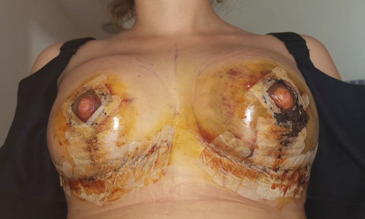 Posible necrosis de areola tras mastopexia - 83986