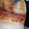 Posible necrosis de areola tras mastopexia